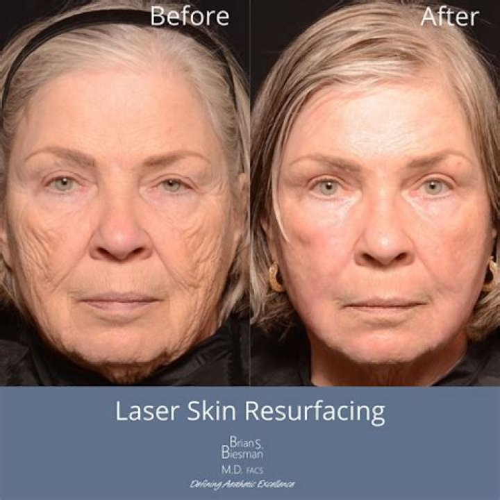 laser skin resurfacing cost