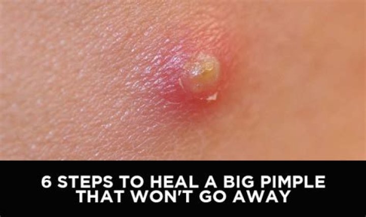 pimple won t go away for months