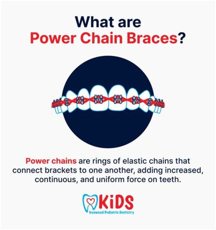 Power Chains Braces Help An Overbite